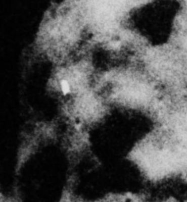 AS 17-157-23862 - Squared Lunar Crater and High-Albedo Lunar Surface Feature (edm; credits: Dr G. Barca)
La conferma che il dettaglio identificato dal Dr Barca (e cioè quella sorta di "pensilina" la cui albedo è di gran lunga superiore all'albedo visuale media del resto del paesaggio a cui il rilievo controverso accede) NON E' un image-artifact, potrebbe arrivare da questo notevole edm.

Osservate: la "pensilina" sembra proiettare una debole ombra (che, purtroppo, si confonde nella brutta tessitura del frame).

Che altro dire? E' una "Stranezza Lunare" (Lunar Oddity). A volte si tratta di rilievi naturali dalle forme bizzarre ed improbabili; altre volte sono Strutture Effimere ed altre volte ancora siamo davanti a degli image-artifacts o, semplicemente, di fronte a dei rilievi indefinibili (ma MOLTO affascinanti e suggestivi).

Ora, come sempre, decidete Voi quale sia la giusta collocazione per questo caso di specie...
Parole chiave: The Moon from orbit - Controversial