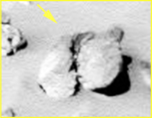 Extremely recent fracture? - Sol 332 (EDM - credits: Ivana Tognoloni)
Il dettaglio, a nostro parere, è INEQUIVOCABILE: la frattura che caratterizza la roccia di Sx è estremamente recente.

E, tutto sommato, di davvero ardua spiegazione.

E le ombre che vediamo (senza esasperare la magnificazione) ci suggeriscono l'eventualità per cui si sia effettivamente davanti, ancora una volta, ad una sorta di "guscio fracassato".
Parole chiave: Martian Surface - Controversial Surface Feature